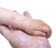 אסטמה של העור אצל פעוטות וילדים