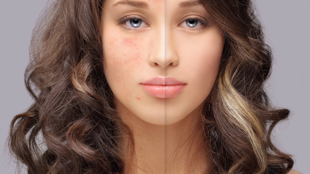 כיצד לאפר נכון עור פנים עם אקנה?